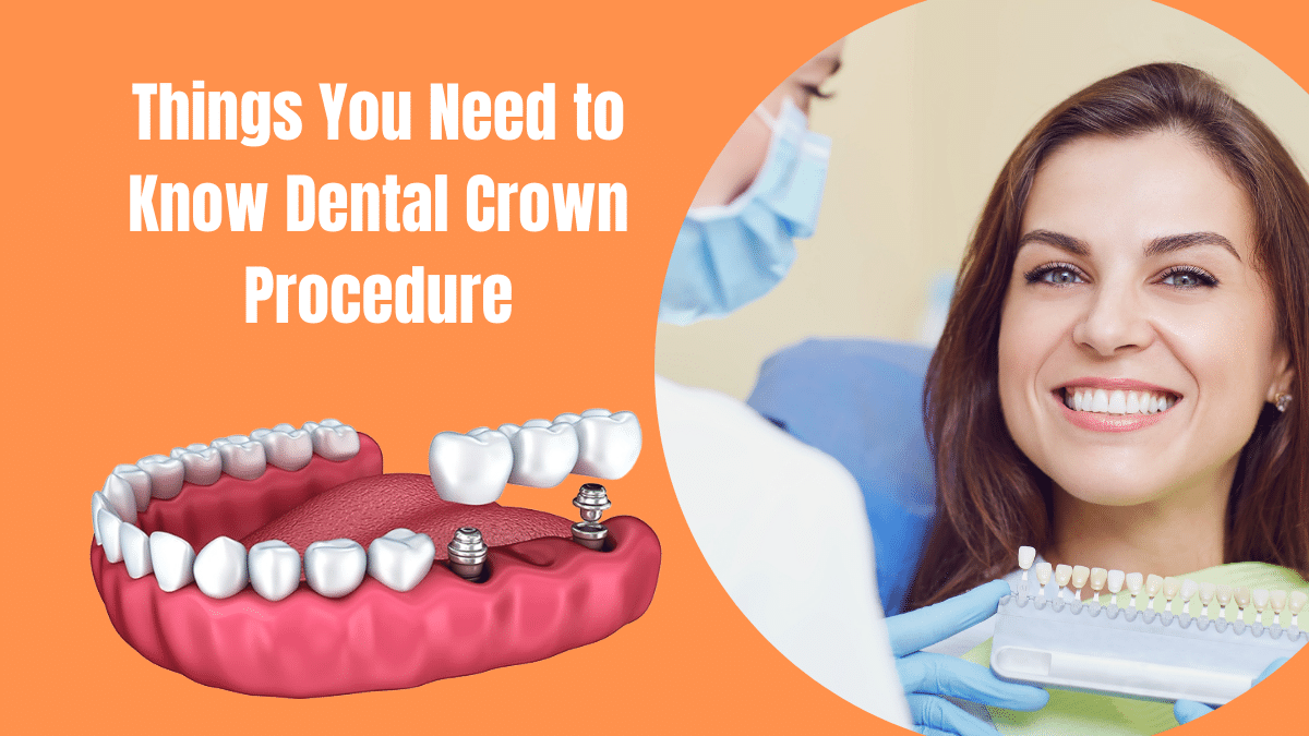Things You Need to Know About Dental Crown Procedure